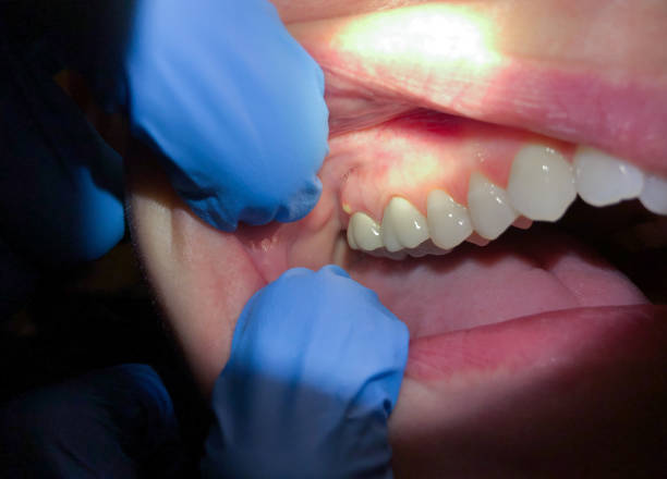 Best Emergency Dental Care for Broken or Chipped Teeth in Martins Ferry, OH